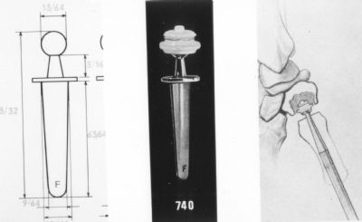 Hand, CMC Joint:  de la Caffiniere (Implant 312)